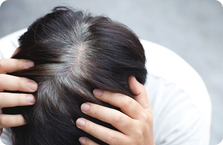 30 வயதிற்குள் நரைமுடி வருகிறதா? கவலை வேண்டாம்: காரணங்களும் எளிமையான இயற்கை தீர்வு முறைகளும்!